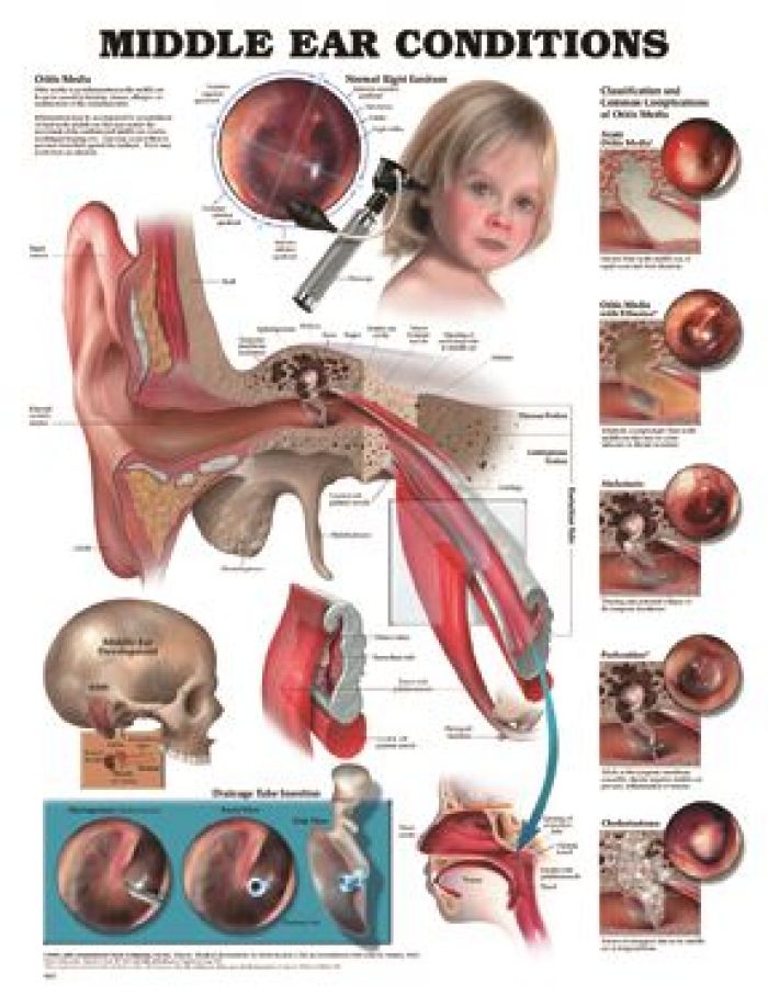 Wall Chart - Understanding Middle Ear Infections - (Single)